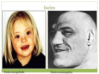 facies




Facies mongoloide      Facies acromegalica
 