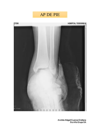 Historia clinica, trauma de atriccion pie izquierdo