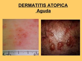 DERMATITIS ATOPICA
      Aguda
 