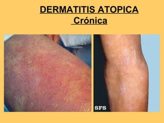 DERMATITIS ATOPICA
     Crónica
 