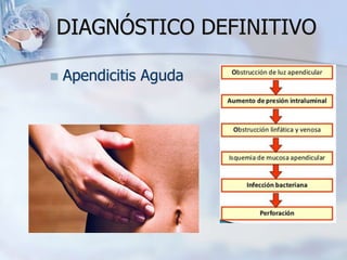 DIAGNÓSTICO DEFINITIVO
 Apendicitis Aguda
 