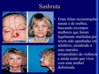 Sushruta
• Eram feitas reconstruções
nasais e de orelhas,
buscando recompor
mulheres que foram
legalmente mutiladas por
terem sido apanhadas em
adultério, atendendo a
seus maridos
arrependidos da violência
e ainda tendo que viver
com uma mulher
deformada.
 