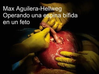 Max Aguilera-Hellweg Operando una espina bífida  en un feto 