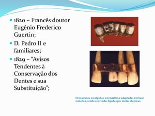  1820 – Francês doutor
Eugênio Frederico
Guertin;
 D. Pedro II e
familiares;
 1829 – “Avisos
Tendentes à
Conservação dos
Dentes e sua
Substituição”;
Dentaduras esculpidas em marfim e adaptadas em base
metálica, sendo as arcadas ligadas por molas elásticas.
 