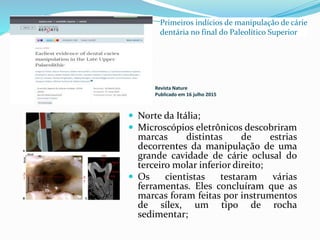 Revista Nature
Publicado em 16 julho 2015
 Norte da Itália;
 Microscópios eletrônicos descobriram
marcas distintas de estrias
decorrentes da manipulação de uma
grande cavidade de cárie oclusal do
terceiro molar inferior direito;
 Os cientistas testaram várias
ferramentas. Eles concluíram que as
marcas foram feitas por instrumentos
de sílex, um tipo de rocha
sedimentar;
Primeiros indícios de manipulação de cárie
dentária no final do Paleolítico Superior
 