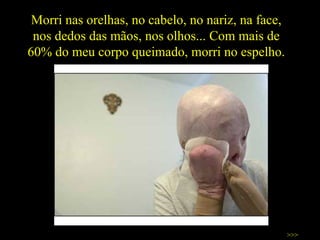 Morri nas orelhas, no cabelo, no nariz, na face, nos dedos das mãos, nos olhos... Com mais de 60% do meu corpo queimado, morri no espelho. >>> 