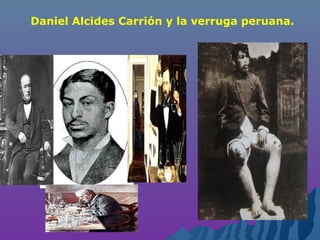 Daniel Alcides Carrión y la verruga peruana.
 