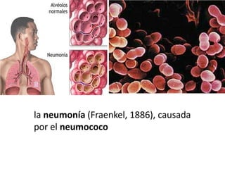 la neumonía (Fraenkel, 1886), causada
por el neumococo
 