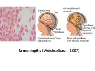 la meningitis (Weichselbaun, 1887)
 