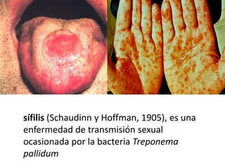 sífilis (Schaudinn y Hoffman, 1905), es una
enfermedad de transmisión sexual
ocasionada por la bacteria Treponema
pallidum
 