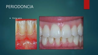 PERIODONCIA
 Encía sana
 
