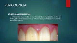 PERIODONCIA
ENFERMEDAD PERIODONTAL
 La enfermedad periodontal es una infección bacteriana de las encías que
destruye las fibras de inserción y el hueso de soporte que mantiene los
dientes en la boca
 