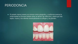 PERIODONCIA
 El estado menos severo se conoce como gingivitis, y conforme avanza la
enfermedad se forman bolsas estas se llenan de infección y destruye mas
tejido, hueso y los dientes eventualmente se aflojan y se pierden.
 