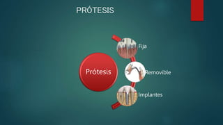 PRÓTESIS
Prótesis
Fija
Removible
Implantes
 