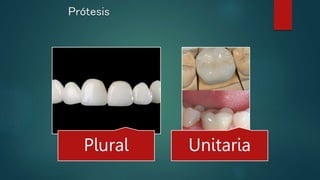 Prótesis
Plural Unitaria
 