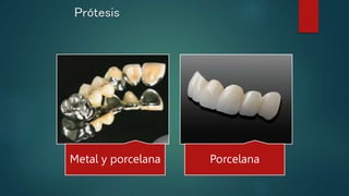 Prótesis
Metal y porcelana Porcelana
 