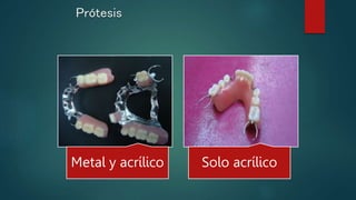 Prótesis
Metal y acrílico Solo acrílico
 