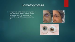 Somatoprótesis
 Son prótesis realizadas para reemplazar
bien sea un ojo, la nariz, oreja o alguna
parte de la cara q ha tenido que ser
removida por problemas cancerígenos,
etc
 