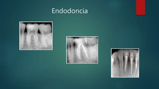 Endodoncia
 