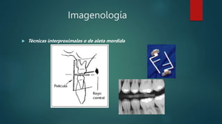 Imagenología
 Técnicas interproximales o de aleta mordida
 