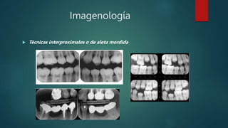 Imagenología
 Técnicas interproximales o de aleta mordida
 