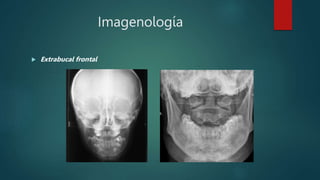 Imagenología
 Extrabucal frontal
 