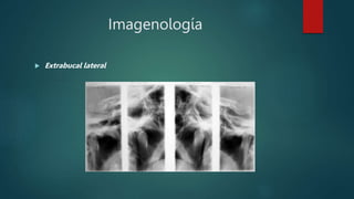 Imagenología
 Extrabucal lateral
 
