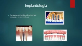 Implantología
 Son pequeños tornillos cilíndricos que
se colocan en los maxilares
 