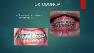 ORTODONCIA
 Tratamiento de ortodoncia
Aparatología fija
 