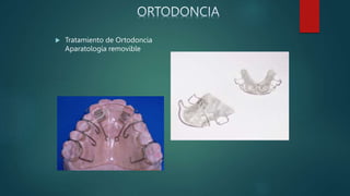  Tratamiento de Ortodoncia
Aparatología removible
 