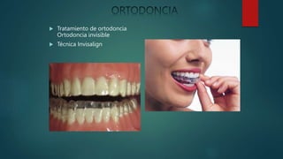  Tratamiento de ortodoncia
Ortodoncia invisible
 Técnica Invisalign
 