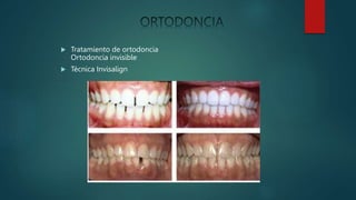  Tratamiento de ortodoncia
Ortodoncia invisible
 Técnica Invisalign
 