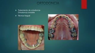  Tratamiento de ortodoncia
Ortodoncia invisible
 Técnica lingual
 