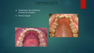 Tratamiento de ortodoncia
Ortodoncia invisible
 Técnica lingual
 