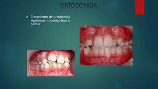  Tratamiento de ortodoncia
Apiñamiento dental, leve o
severo
 