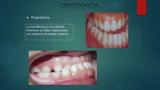  Prognatismo
La mandíbula y/o los dientes
inferiores se hallan adelantados
con respecto al maxilar superior.
 