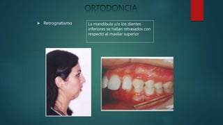  Retrognatismo La mandíbula y/o los dientes
inferiores se hallan retrasados con
respecto al maxilar superior
 