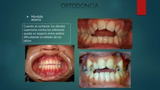  Mordida
abierta
Cuando al contactar los dientes
superiores contra los inferiores
queda un espacio entre ambos
dificultando el sellado de los
labios
 