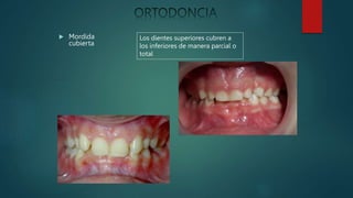  Mordida
cubierta
Los dientes superiores cubren a
los inferiores de manera parcial o
total
 