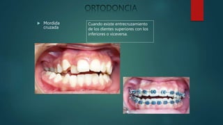  Mordida
cruzada
Cuando existe entrecruzamiento
de los dientes superiores con los
inferiores o viceversa.
 