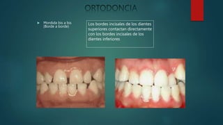  Mordida bis a bis
(Borde a borde)
Los bordes incisales de los dientes
superiores contactan directamente
con los bordes incisales de los
dientes inferiores
 