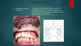  Mordida en tijeras
(Colapso)
La relación normal entre maxilar superior y
mandíbula guarda un patrón conocido como
"tijera" (al morder, los dientes superiores cubren
ligeramente a los inferiores
 