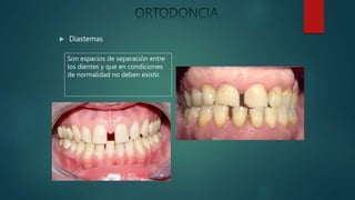  Diastemas
Son espacios de separación entre
los dientes y que en condiciones
de normalidad no deben existir.
 