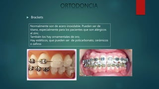  Brackets
Normalmente son de acero inoxidable. Pueden ser de
titano, especialmente para los pacientes que son alérgicos
al zinc.
También los hay ornamentales de oro.
Hay estéticos, que pueden ser de policarbonato, cerámicos
o zafiros
 