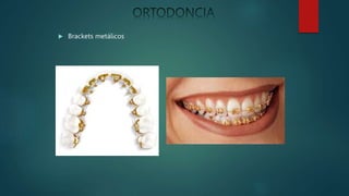  Brackets metálicos
 