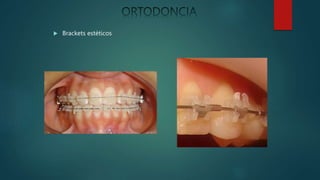  Brackets estéticos
 