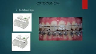  Brackets estéticos
 