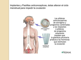 Implantes y Pastillas anticonceptivas, éstas alteran el ciclo menstrual para impedir la ovulación