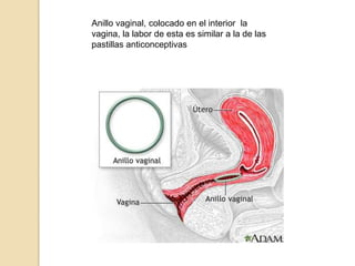 Anillo vaginal, colocado en el interior  la vagina, la labor de esta es similar a la de las pastillas anticonceptivas