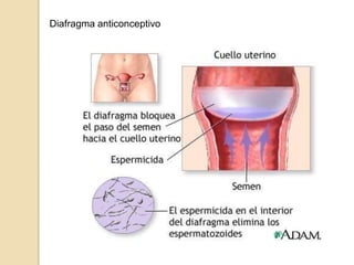 Diafragma anticonceptivo